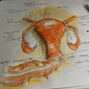 Foco em uma cirurgia minimamente invasiva para o tratamento cirúrgico da endometriose profunda que afeta o intestino.
