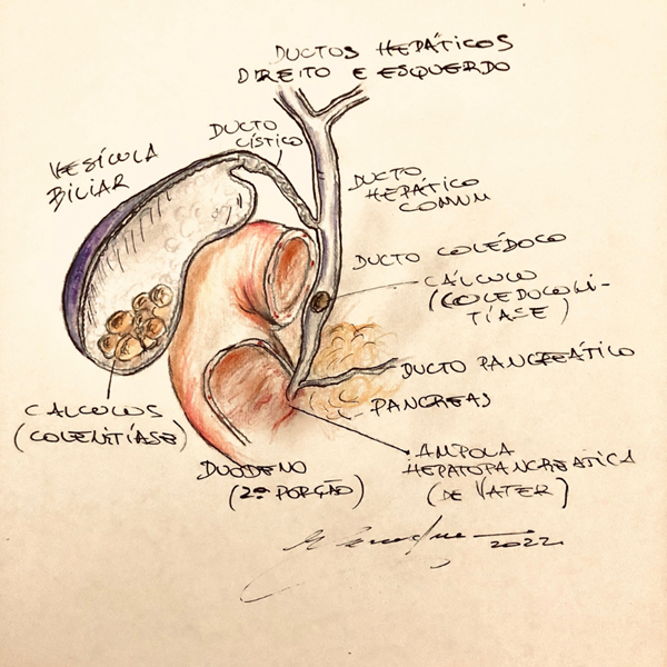 Modelo anatômico da vesícula biliar com múltiplas pedras (cálculos) em seu interior, ilustrando a causa da dor e dos riscos.