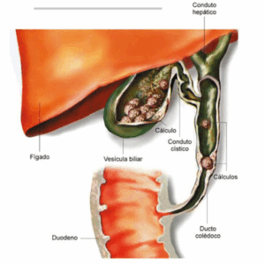 Ilustração detalhada mostrando uma pedra obstruindo o canal do fígado, condição conhecida como coledocolitíase.