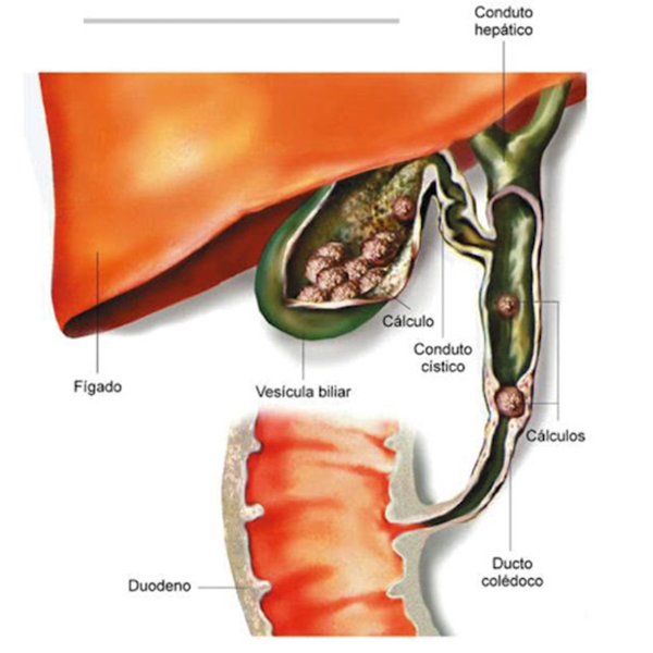 Ilustração detalhada mostrando uma pedra obstruindo o canal do fígado, condição conhecida como coledocolitíase.